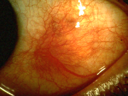 Scleritis.png